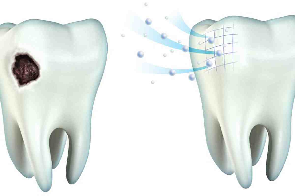 Реставрация эмали как один из методов реставрации зубов